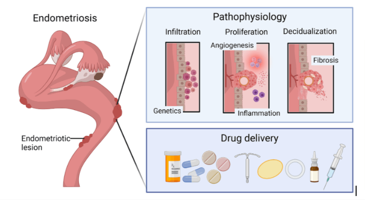 Endometriosis and Inflammation