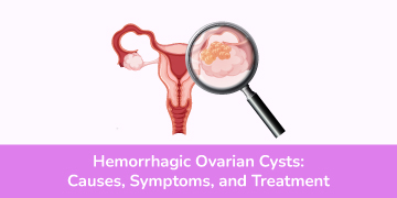 Hemorrhagic-Ovarian-Cysts-Causes,-Symptoms,-and-Treatment