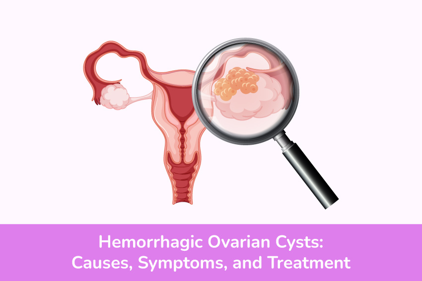 Hemorrhagic Ovarian Cysts: How to Identify and Treat Them?