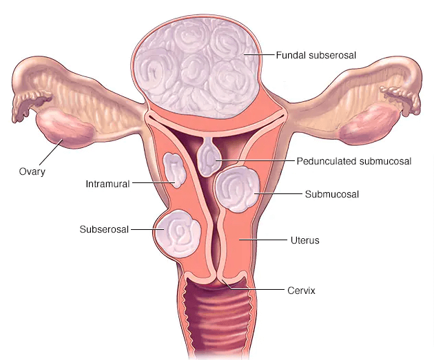 Understanding Fibroids